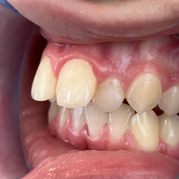 fotografía intraoral de perfil que muestra el resalte dental y los dientes inferiores retrasados antes de usar alineadores invisibles