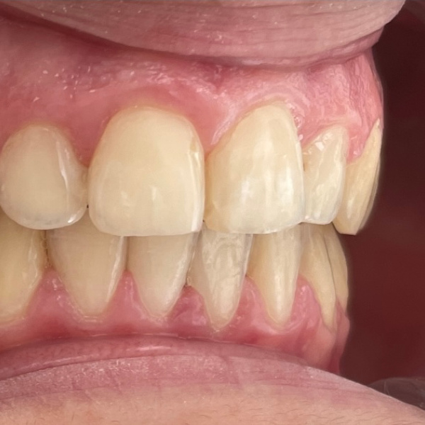 Resultado final de la sonrisa alineada de Aaroa tras 15 meses de ortodoncia invisible en clínica dental dr. Lorente